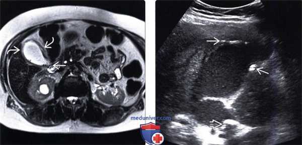 УЗИ, КТ при остром калькулезном холецистите