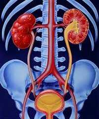 Пиелонефрит