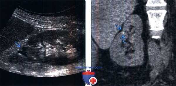 КТ, УЗИ при хроническом пиелонефрите и рефлюкс-нефропатии