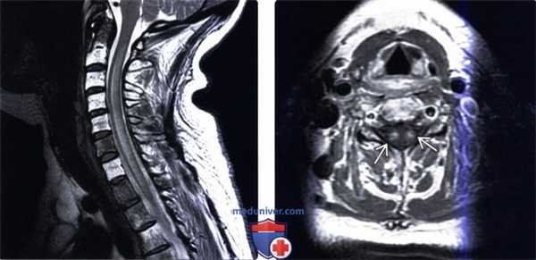МРТ при острой поперечной миелопатии