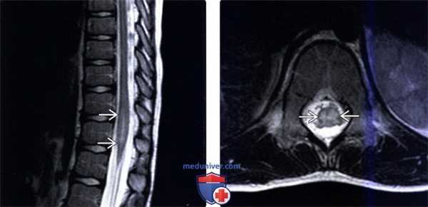 МРТ при идиопатическом остром поперечном миелите