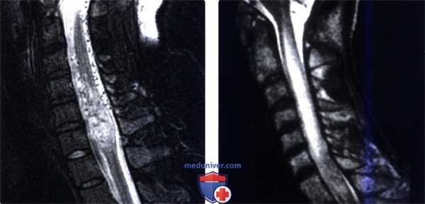 МРТ при острой поперечной миелопатии
