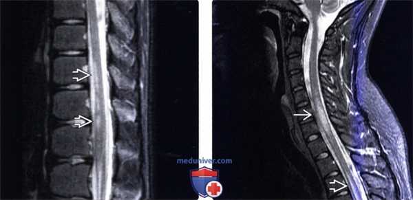 МРТ при острой поперечной миелопатии