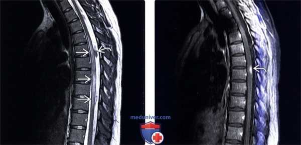МРТ при идиопатическом остром поперечном миелите