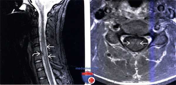 МРТ при идиопатическом остром поперечном миелите