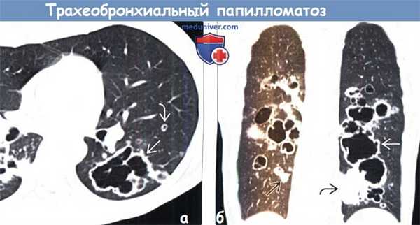 Трахеобронхиальный папилломатоз на КТ