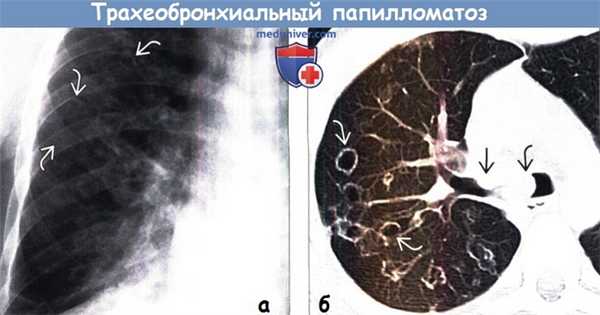 Трахеобронхиальный папилломатоз на рентгенограмме и КТ
