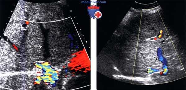 Дифференциальная диагностика синдрома Бадда-Киари