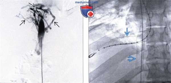 КТ, МРТ, УЗИ признаки синдрома Бадда-Киари