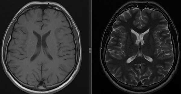 Виды МРТ головного мозга