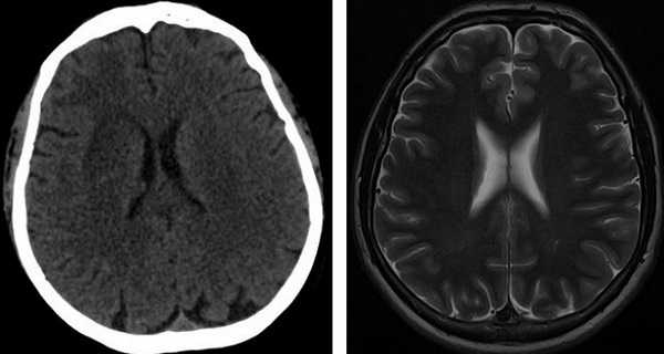 МРТ головы, что показывает