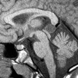 gpineal_cyst_fig1a