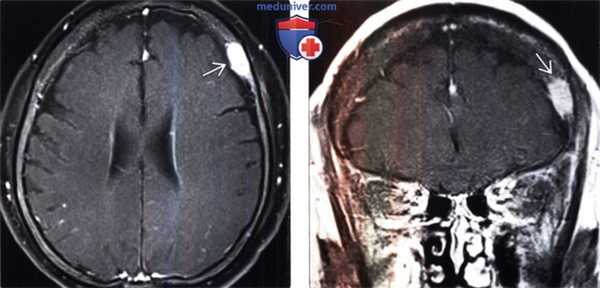 МРТ признаки метастазов в череп и мозговые оболочки