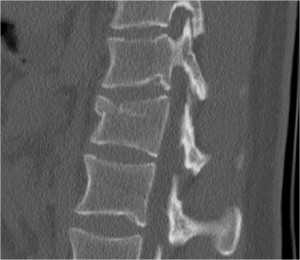 компрессионный перелом - реформация КТ