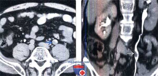 КТ, урография при переходноклеточном раке мочеточника