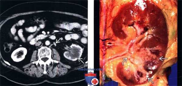 КТ при переходноклеточном раке почки
