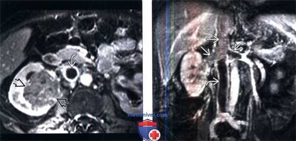 КТ при переходноклеточном раке почки