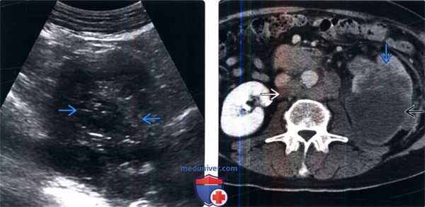 КТ при переходноклеточном раке почки