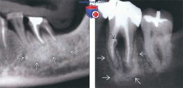 Лучевая диагностика периапикального склерозирующего остеита зуба