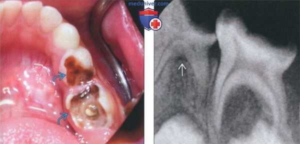 Рентгенограмма, КТ при периапикальном рарефицирующем остеите зуба