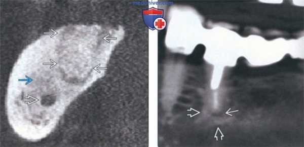 Лучевая диагностика периапикального склерозирующего остеита зуба