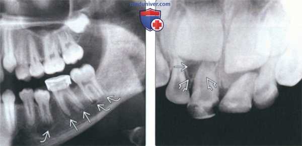 Рентгенограмма, КТ при периапикальном рарефицирующем остеите зуба