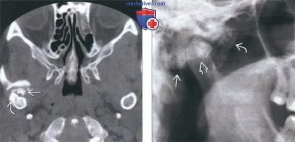 КТ, МРТ при первичном синовиальном хондроматозе височно-нижнечелюстного сустава (ВНЧС)