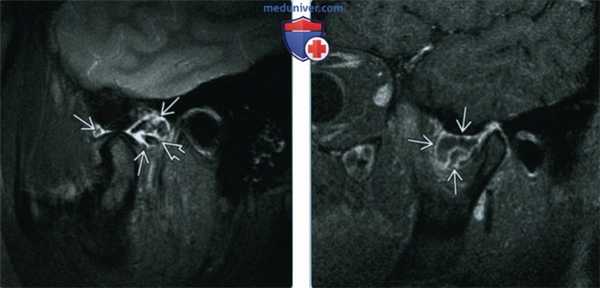 Синовиальный хондроматоз височно-нижнечелюстного сустава (ВНЧС) - лучевая диагностика