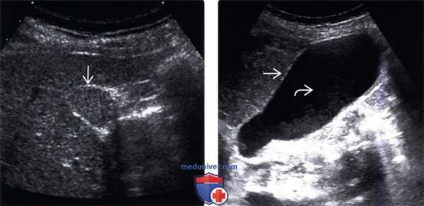 УЗИ при песке в желчном пузыре (эхогенной желчи)