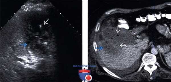 УЗИ, КТ при остром бескаменном холецистите