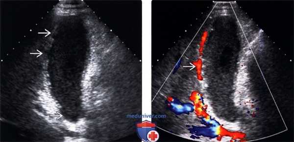 УЗИ при остром бескаменном холецистите