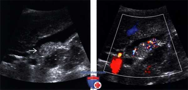 УЗИ при песке в желчном пузыре (эхогенной желчи)
