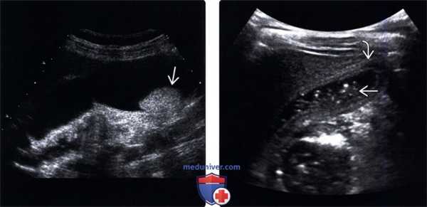 УЗИ при песке в желчном пузыре (эхогенной желчи)