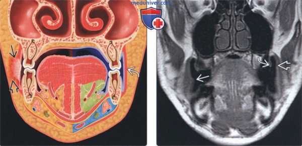Лучевая диагностика плоскоклеточного рака слизистой оболочки щеки