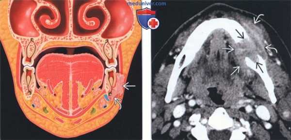 Лучевая диагностика плоскоклеточного рака десны