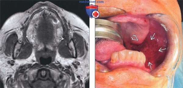 Лучевая диагностика плоскоклеточного рака слизистой оболочки щеки