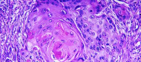 плоскоклеточный рак микрофотография