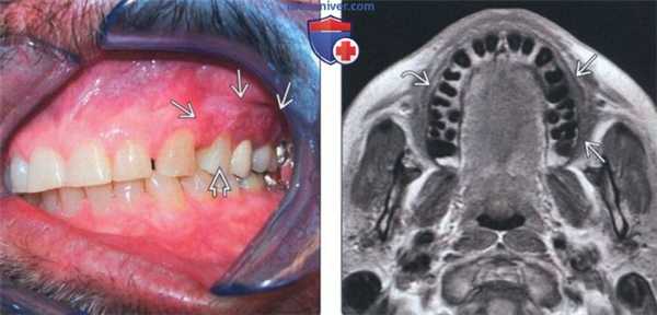 Лучевая диагностика плоскоклеточного рака десны