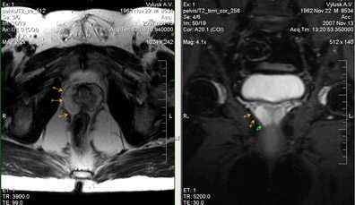  МРТ малого таза в диагностике заболеваний предстательной железы