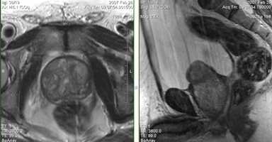  МРТ малого таза в диагностике заболеваний предстательной железы