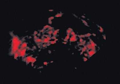 Эхограмма: патологические изменения в сосудах при раке предстательной железы в случае подкапсульной опухоли (энергетическое картирование + 3D)