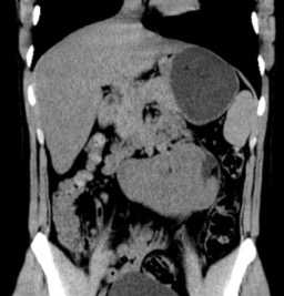 Horseshoe kidney on CT