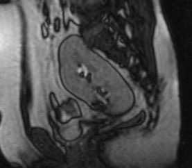 pelvic kidney
