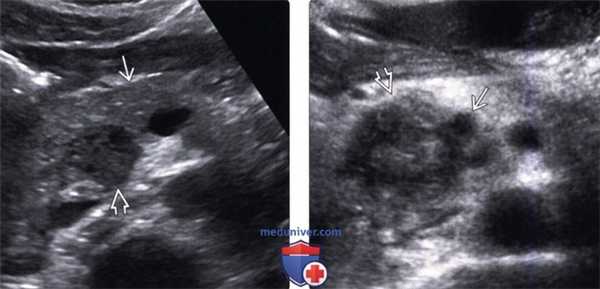 УЗИ при раке протока поджелудочной железы