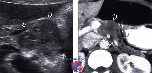 УЗИ при раке протока поджелудочной железы