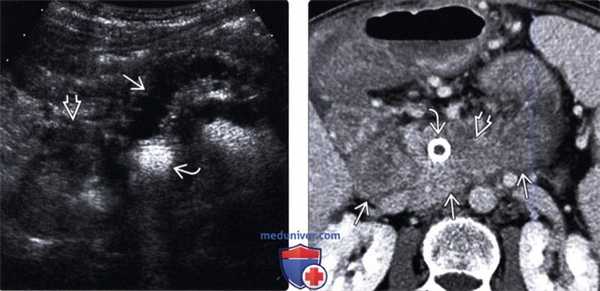 УЗИ при раке протока поджелудочной железы