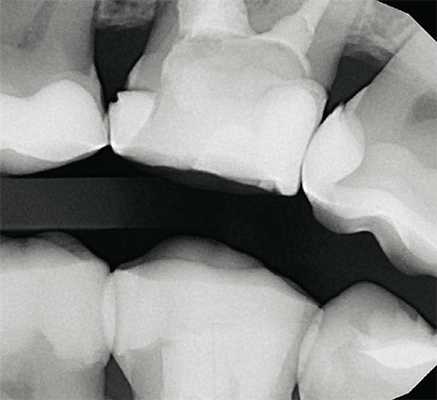 Рис. 4. Интерпроксимальный снимок, выполненный в технике bitewing, исследование состояния контактных пунктов моляров верхней челюсти.