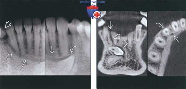 Лучевая диагностика проводника зуба