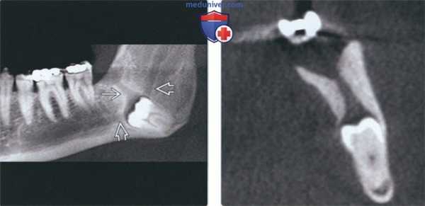 Лучевая диагностика проводника зуба