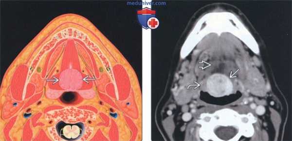 Лучевая диагностика язычной щитовидной железы